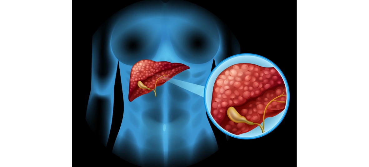 Pancreatic Cancer Treatment at GEM Hospital