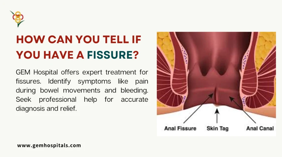 How Can You Tell If You Have a Fissure Key Symptoms and Signs